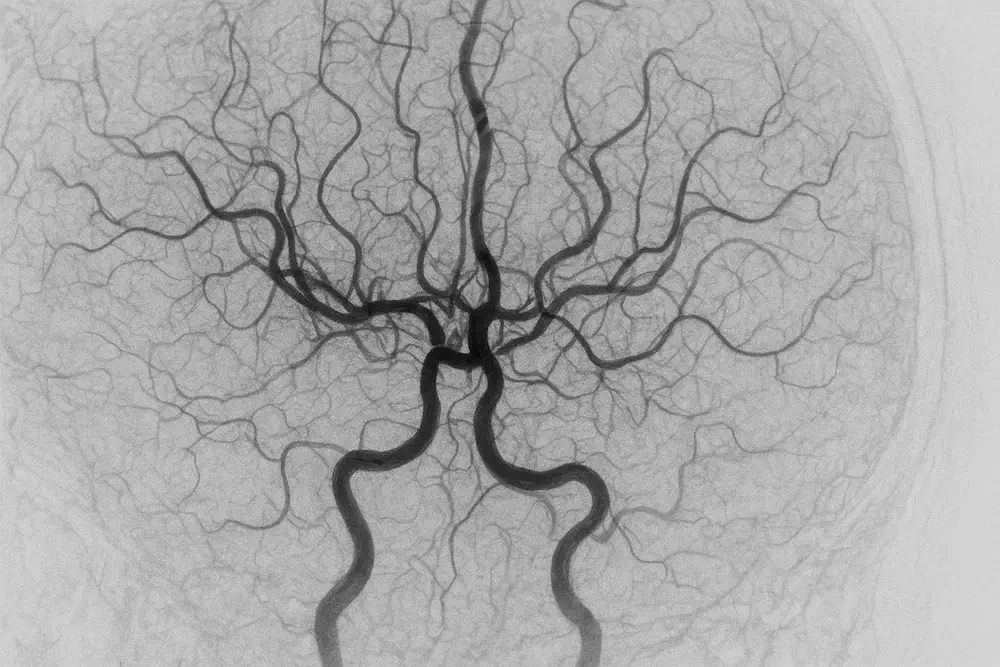 Neurointervenção cerebral com angiografia